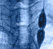 Vascular and Interventional Radiology (VIR)